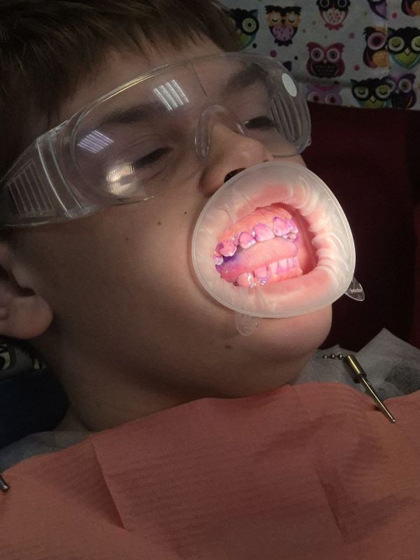 Цветная проверка чистоты зубов